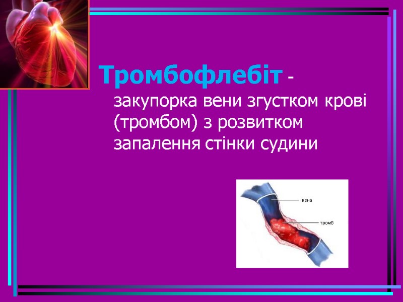 Тромбофлебіт - закупорка вени згустком крові (тромбом) з розвитком запалення стінки судини